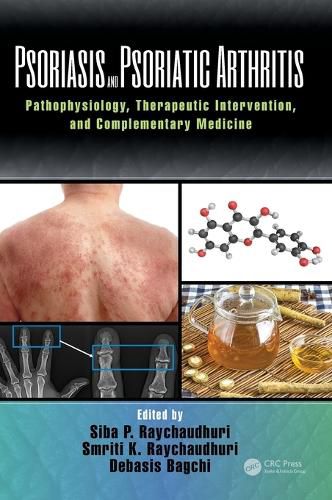 Cover image for Psoriasis and Psoriatic Arthritis: Pathophysiology, Therapeutic Intervention, and Complementary Medicine