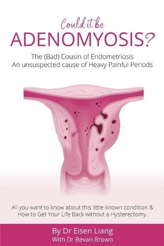 Cover image for Adenomyosis -The Bad Cousin of Endometriosis: An unsuspected cause of Heavy Painful Periods
