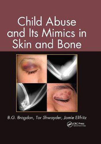 Cover image for Child Abuse and Its Mimics in Skin and Bone