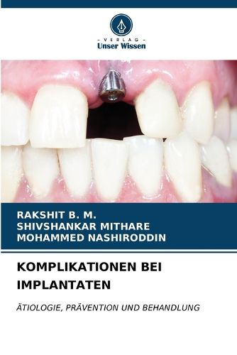 Cover image for Komplikationen Bei Implantaten