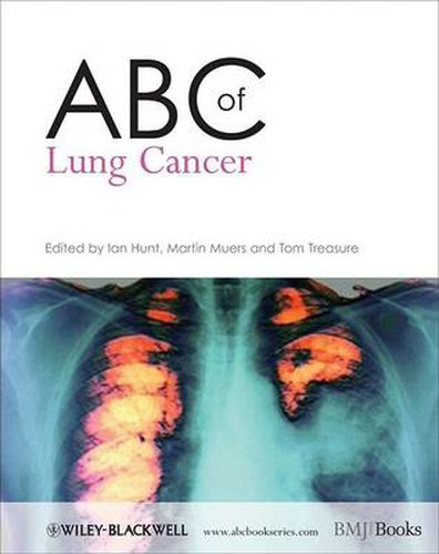 Cover image for ABC of Lung Cancer