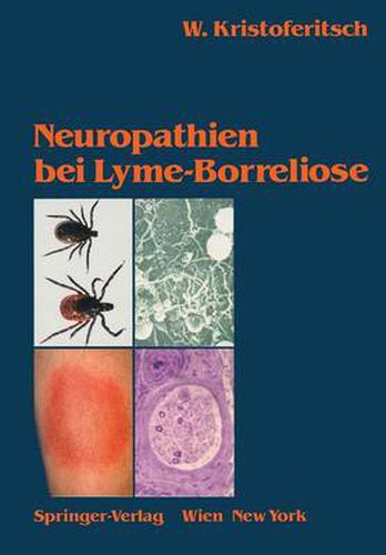 Cover image for Neuropathien Bei Lyme-Borreliose