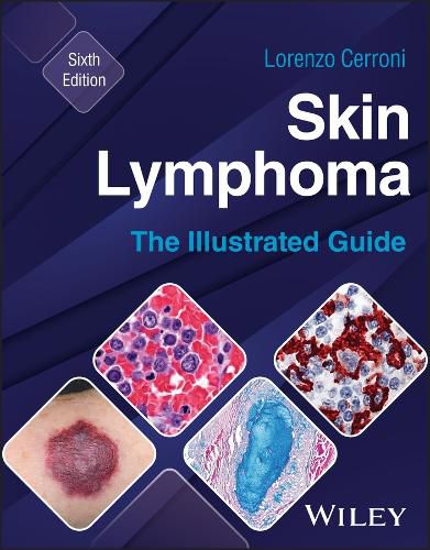 Cover image for Skin Lymphoma
