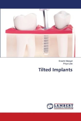 Cover image for Tilted Implants