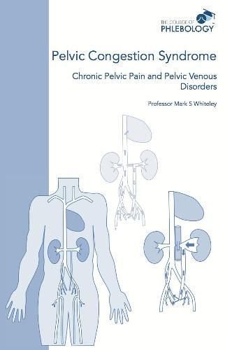 Cover image for Pelvic Congestion Syndrome - Chronic Pelvic Pain and Pelvic Venous Disorders