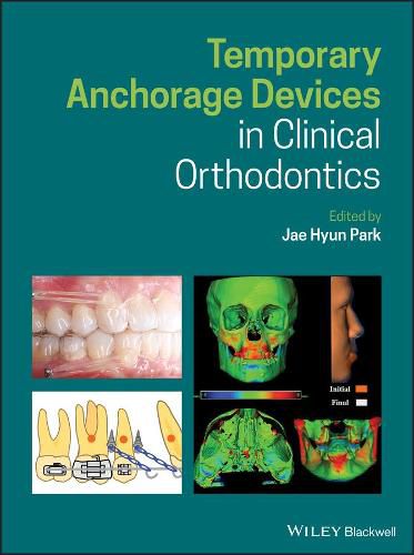 Cover image for Temporary Anchorage Devices in Clinical Orthodontics