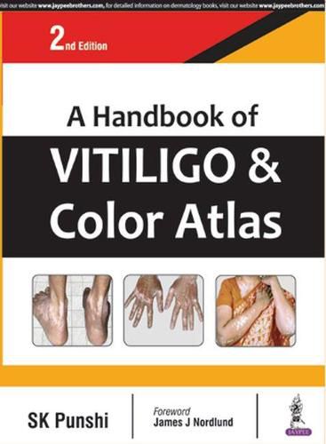 Cover image for A Handbook of Vitiligo & Color Atlas