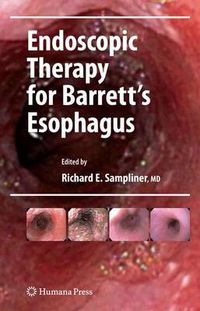 Cover image for Endoscopic Therapy for Barrett's Esophagus