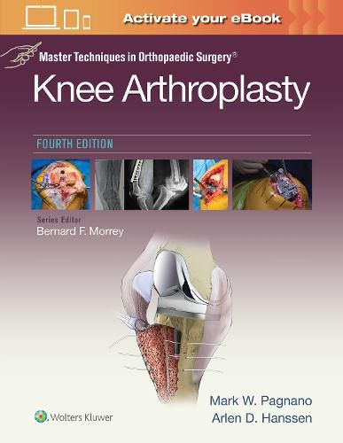 Cover image for Master Techniques in Orthopedic Surgery: Knee Arthroplasty