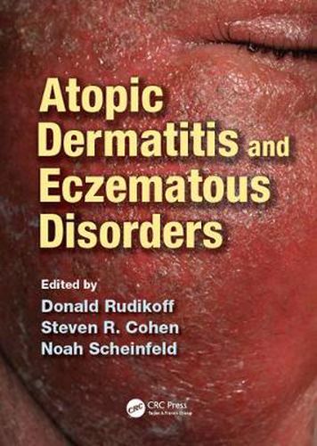 Cover image for Atopic Dermatitis and Eczematous Disorders