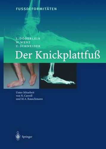 Cover image for Fussdeformitaten: Der Knickplattfuss