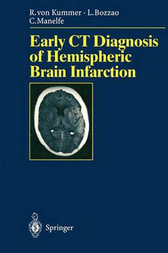 Cover image for Early CT Diagnosis of Hemispheric Brain Infarction