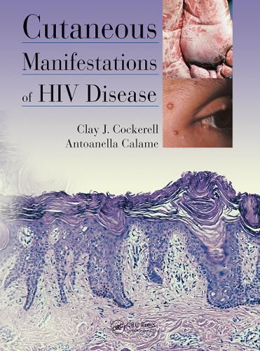 Cover image for Cutaneous Manifestations of HIV Disease