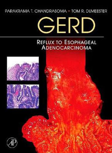 Cover image for GERD: Reflux to Esophageal Adenocarcinoma