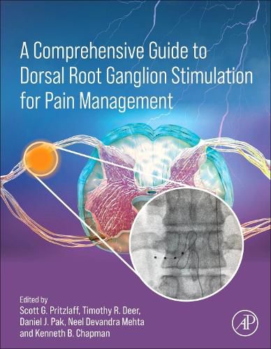 Cover image for A Comprehensive Guide to Dorsal Root Ganglion Stimulation for Pain Management