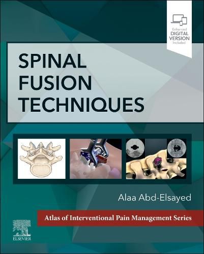 Cover image for Spinal Fusion Techniques