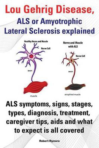 Cover image for Lou Gehrig Disease, ALS or Amyotrophic Lateral Sclerosis explained. ALS symptoms, signs, stages, types, diagnosis, treatment, caregiver tips, aids and what to expect all covered.