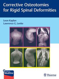 Cover image for Corrective Osteotomies for Rigid Spinal Deformities