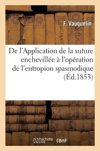 Cover image for de l'Application de la Suture Enchevillee A l'Operation de l'Entropion Spasmodique: Au Moyen d'Une Nouvelle Espece de Cheville, Cheville Jumelle Ou A Double Branche