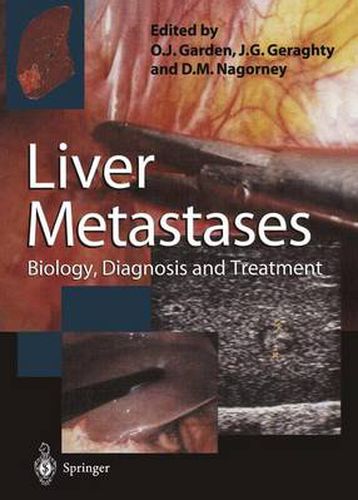 Cover image for Liver Metastases: Biology, Diagnosis and Treatment