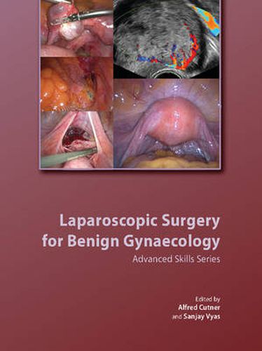Cover image for Laparoscopic Surgery for Benign Gynaecology Hardback with DVDs