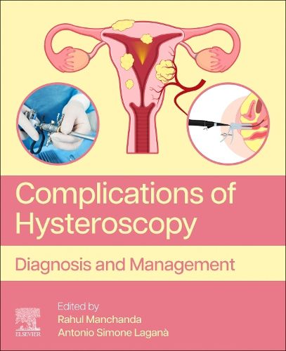 Cover image for Complications of Hysteroscopy