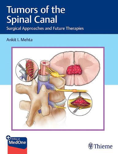 Cover image for Tumors of the Spinal Canal: Surgical Approaches and Future Therapies