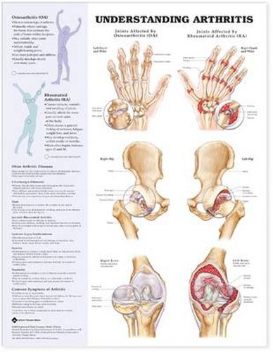 Cover image for Understanding Arthritis Anatomical Chart