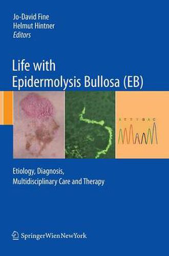 Life with Epidermolysis Bullosa (EB): Etiology, Diagnosis, Multidisciplinary Care and Therapy