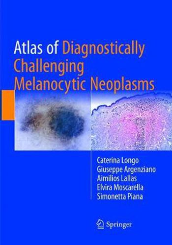 Cover image for Atlas of Diagnostically Challenging Melanocytic Neoplasms