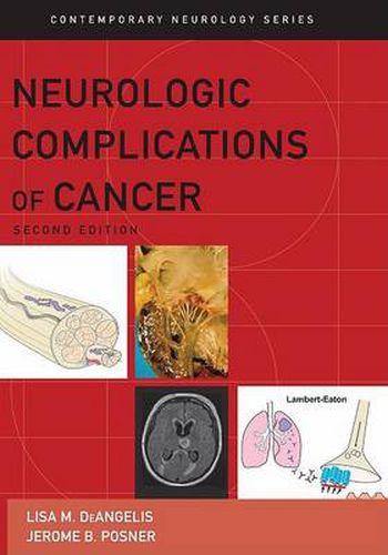 Cover image for Neurologic Complications of Cancer