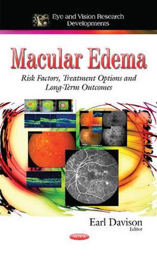 Cover image for Macular Edema: Risk Factors, Treatment Options and Long-Term Outcomes