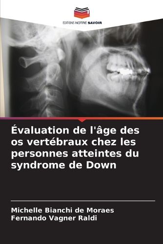 Cover image for Evaluation de l'age des os vertebraux chez les personnes atteintes du syndrome de Down