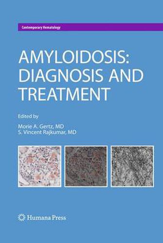 Cover image for Amyloidosis: Diagnosis and Treatment