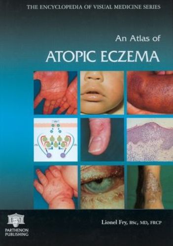 Cover image for An Atlas of Atopic Eczema