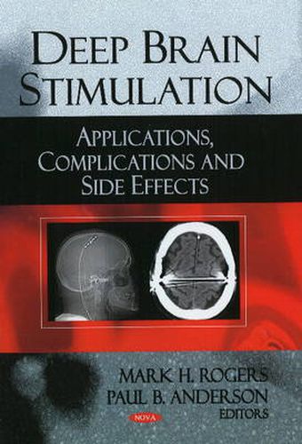 Deep Brain Stimulation: Applications, Complications & Side Effects