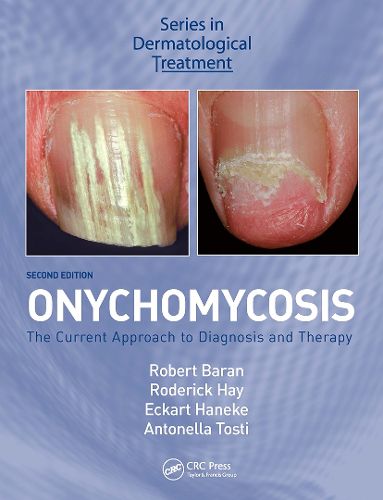 Cover image for Onychomycosis