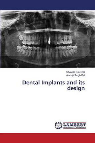 Cover image for Dental Implants and Its Design