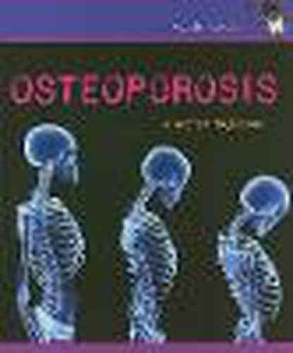 Cover image for Osteoporosis