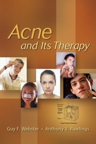 Acne and Its Therapy