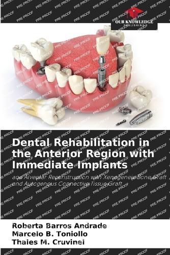 Cover image for Dental Rehabilitation in the Anterior Region with Immediate Implants