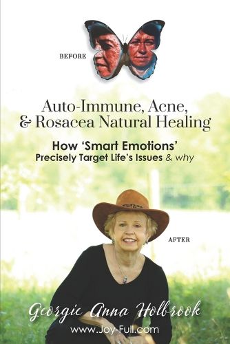 Cover image for Auto-Immune, Acne, & Rosacea Natural Healing - How 'Smart Emotions' Precisely Target Life's Issues & Why