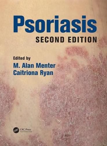 Cover image for Psoriasis