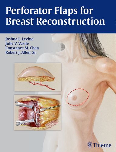 Cover image for Perforator Flaps for Breast Reconstruction