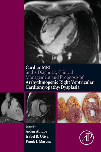 Cover image for Cardiac MRI in Diagnosis, Clinical Management, and Prognosis of Arrhythmogenic Right Ventricular Cardiomyopathy/Dysplasia