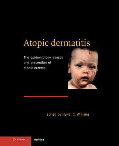 Cover image for Atopic Dermatitis: The Epidemiology, Causes and Prevention of Atopic Eczema