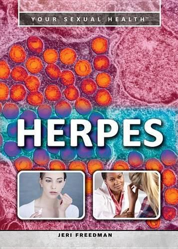 Herpes