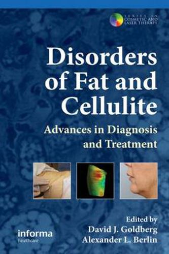 Cover image for Disorders of Fat and Cellulite: Advances in Diagnosis and Treatment