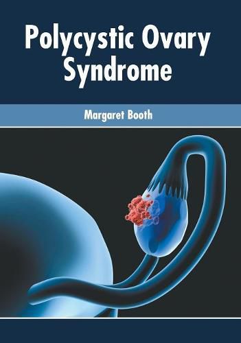 Cover image for Polycystic Ovary Syndrome