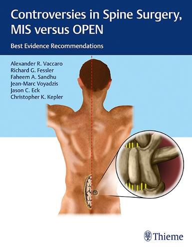 Controversies in Spine Surgery, MIS versus OPEN: Best Evidence Recommendations